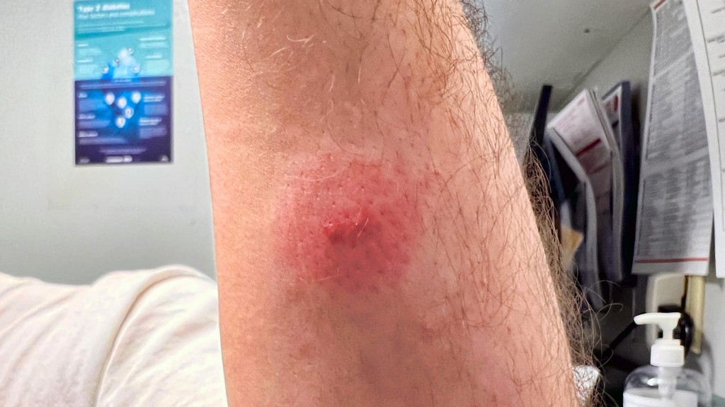 Ein Mann hat rote Hautirritationen am Arm nach Kontakt mit einem Insekt